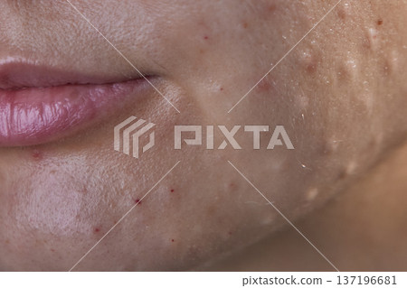 Injectable cosmetology. Facial biorevitalization procedure using a hyaluronic acid-based product. Papules on female face after biorevitalization. close-up 137196681