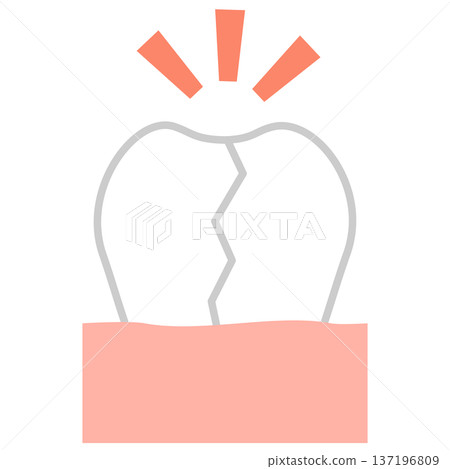 Illustration of vertical root fracture Dental image of cracked or broken teeth Illustration of vertical root fracture Dental image of cracked or broken teeth 137196809