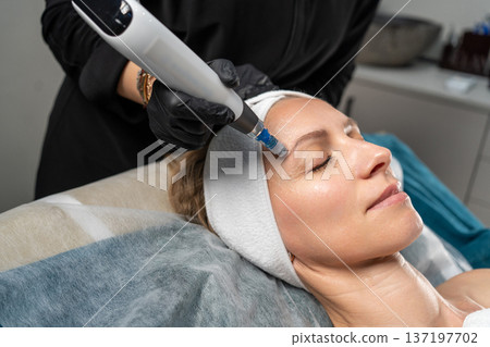 Woman undergoing microneedling procedure on her face for skin care at a dermatology clinic Woman undergoing microneedling procedure on her face for skin care at a dermatology clinic 137197702