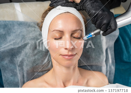 Woman in spa having professional microneedling treatment on her face for rejuvenation 137197718