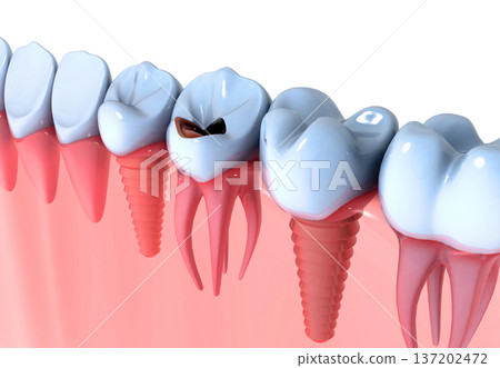 Dental implants instead of Damaged Teeth Dental implants instead of Damaged Teeth 137202472