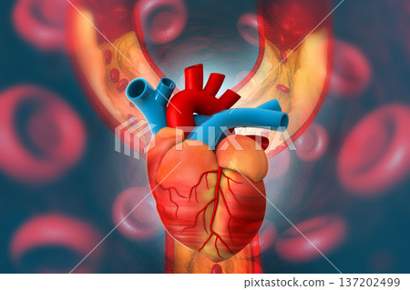 Cholesterol plaque in artery with Human heart anatomy Cholesterol plaque in artery with Human heart anatomy 137202499