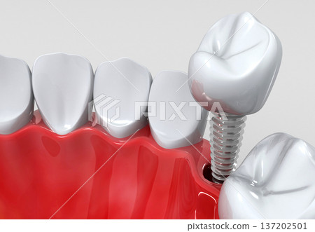Dental implants instead of Damaged Teeth 137202501