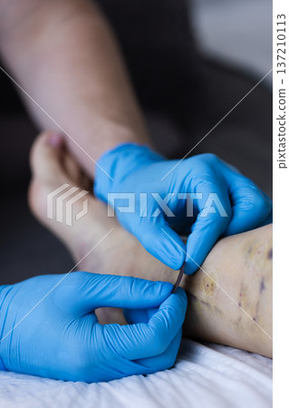 Doctor applies the stick on bandage to cover the small cuts after operation. Doctor applies the stick on bandage to cover the small cuts after operation. 137210113