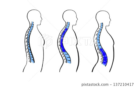 Scoliosis spine deformity Scoliosis spine deformity 137210417