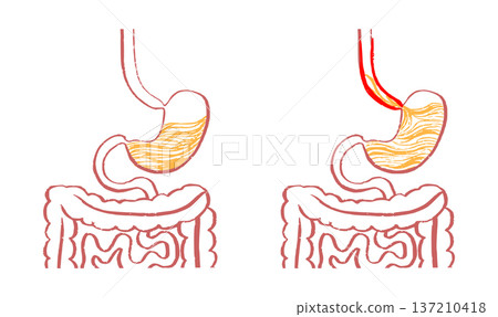 Gastroesophageal reflux pain Gastroesophageal reflux pain 137210418