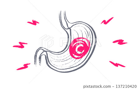 Gastroesophageal reflux pain 137210420