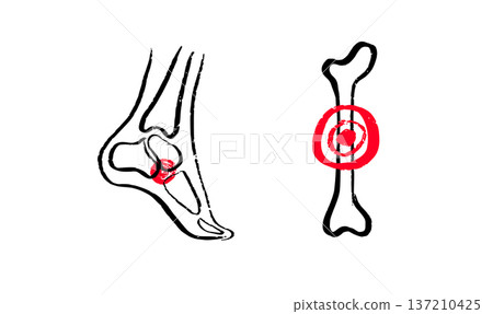Osteomyelitis disease sketch Osteomyelitis disease sketch 137210425