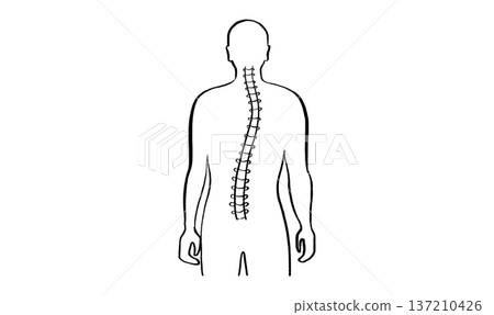 Scoliosis spine deformity 137210426