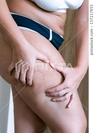 Woman fat problem. Female touching waistline skin close view. Ph Woman fat problem. Female touching waistline skin close view. Ph 137217655