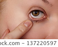 Closeup Eye Finger Pulling Lower Eyelid Revealing Irritated Sclera Faint Makeup Residue Detailed Skin Texture And Tear Film Conveying Discomfort Selfexamination And Vision Health Awareness 137220597