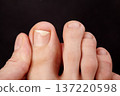 Closeup macro view of toe skin and nails. Nail detachment, fungal nail infection, onycholysis. Dermatologist or therapeutic pedicure examination, careful inspection of toenail condition, skin health 137220598