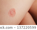 Detailed Skin Problem. Rosea, Highresolution Image Emphasizing Skin Irregularities And Rashes Distinctly. Closeup Shot Revealing Detailed Skin Lesions And Surface Irregularities With Magnification 137220599