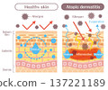 Illustrations of skin structure explaining the differences between atopic skin and healthy skin (barrier function, inflammation, allergens) 137221189