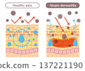 Illustrations of skin structure explaining the differences between atopic skin and healthy skin (barrier function, inflammation, allergens) 137221190