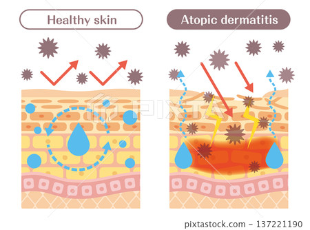 皮膚結構圖解，解釋了異位性皮膚炎皮膚和健康皮膚之間的差異（屏障功能、發炎、過敏原） 137221190