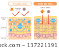 Illustration of skin structure (dryness and moisture balance) explaining the difference between inner dry skin and healthy skin 137221191