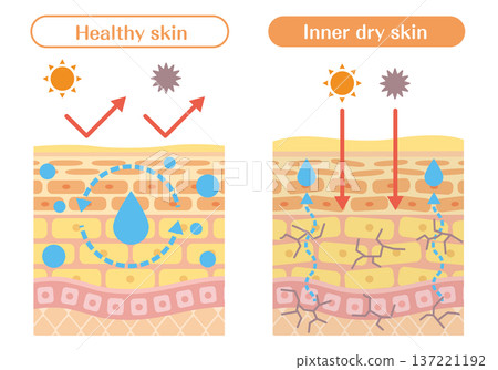 Illustration of skin structure (dryness and moisture balance) explaining the difference between inner dry skin and healthy skin 137221192
