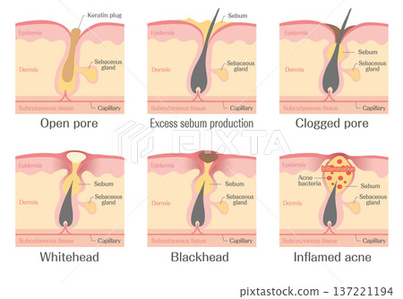 痤瘡發展及毛孔阻塞（白頭、黑頭、發炎）示意圖 137221194