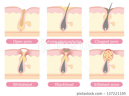 Diagram of acne development and clogged pores (whiteheads, blackheads, inflammation) 137221195