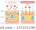 A cross-sectional illustration of the skin explaining the difference between normal and impaired skin barrier function 137221196