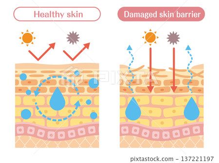 A cross-sectional illustration of the skin explaining the difference between normal and impaired skin barrier function A cross-sectional illustration of the skin explaining the difference between normal and impaired skin barrier function 137221197