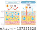 Illustration of skin structure explaining the difference between dry skin and healthy skin (water evaporation and external stimuli) 137221328