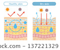 Illustration of skin structure explaining the difference between dry skin and healthy skin (water evaporation and external stimuli) 137221329