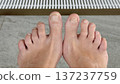 Problem nails in need of treatment, concept of higiene in swimming pool 137237759
