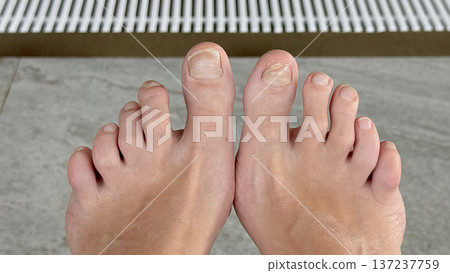 Problem nails in need of treatment, concept of higiene in swimming pool 137237759