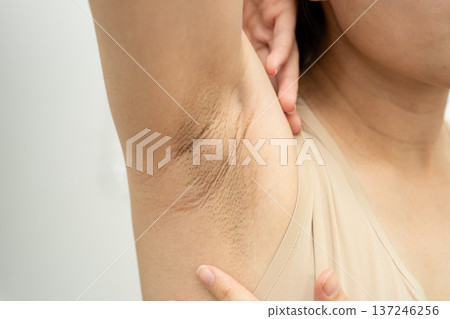 Asian woman have problem black armpit beauty skin care. 137246256