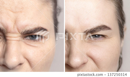 Collage of a face with expression lines. Wrinkle injections. Face before and after the procedure at a cosmetologist photo Collage of a face with expression lines. Wrinkle injections. Face before and after the procedure at a cosmetologist photo 137250314
