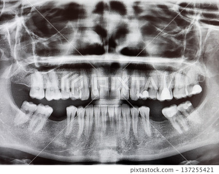 Panoramic dental X ray showing adult teeth and jaw structure 137255421