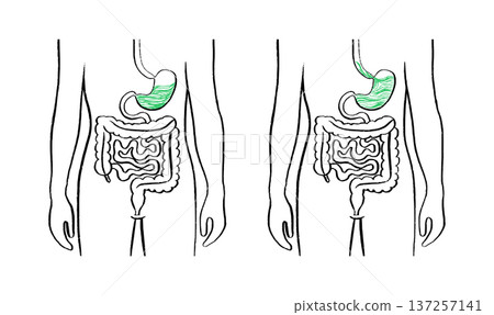 Gastroesophageal reflux pain 137257141