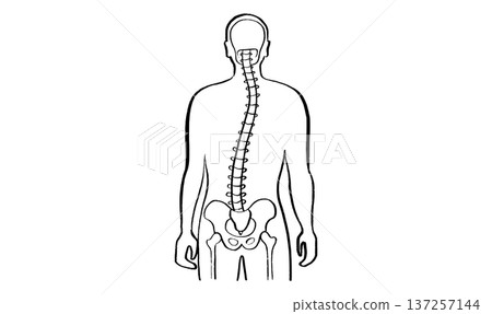 Scoliosis spine deformity 137257144