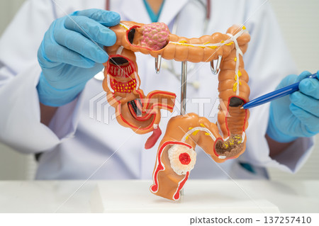 Colorectal cancer, doctor holding intestine colon human anatomy model. Colorectal cancer, doctor holding intestine colon human anatomy model. 137257410
