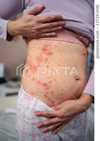 Woman showing red rash on stomach skin 137261698