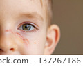 Close-up of young child's face with scratch under eye 137267186