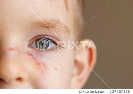 Close-up of young child's face with scratch under eye Close-up of young child's face with scratch under eye 137267186