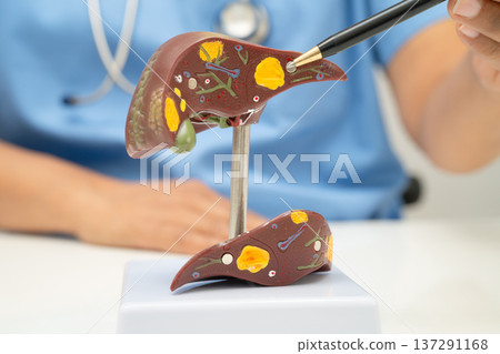 Cirrhosis, Liver cancer, fatty liver, Asian doctor with liver human model. 137291168
