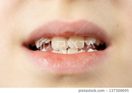 Child with crowded teeth. Crooked permanent and baby teeth in a 8 year old child mouth. Child with crowded teeth. Crooked permanent and baby teeth in a 8 year old child mouth. 137300695