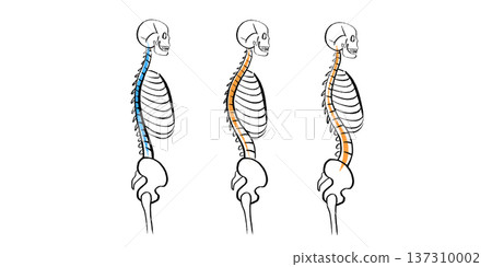Scoliosis spine deformity Scoliosis spine deformity 137310002