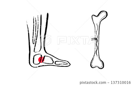 Osteomyelitis disease sketch Osteomyelitis disease sketch 137310016