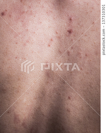 Closeup human skin with problem Closeup human skin with problem 137310301