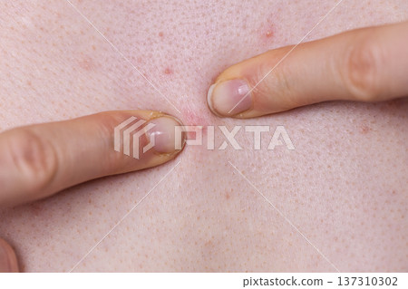 Woman dealing with pimples red spots Woman dealing with pimples red spots 137310302