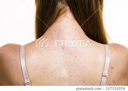 Woman with skin problem acne on back Woman with skin problem acne on back 137310359