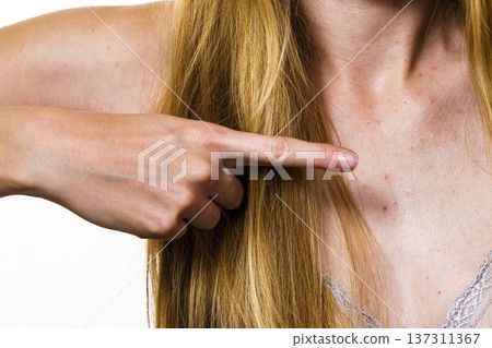 Woman with skin problem acne on neckline 137311367