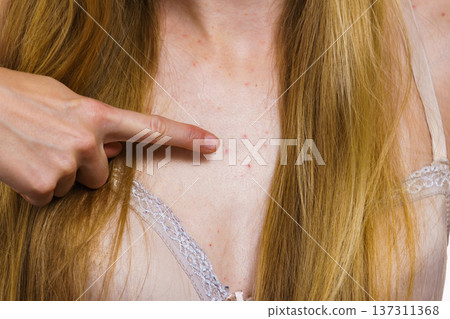Woman with skin problem acne on neckline 137311368