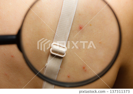 Closeup skin with acne moles and red spots. 137311373