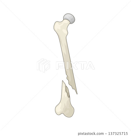 Illustration of Bone Fracture Illustration of Bone Fracture 137325715